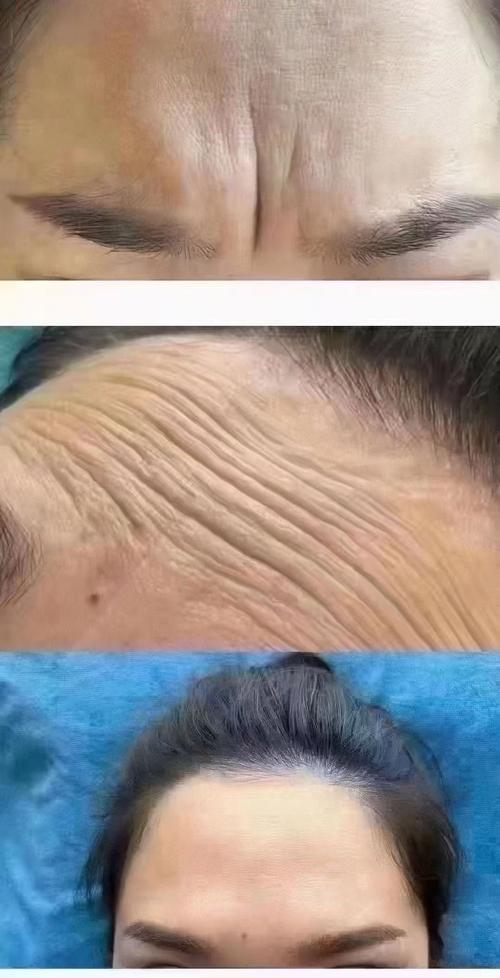 皱纹